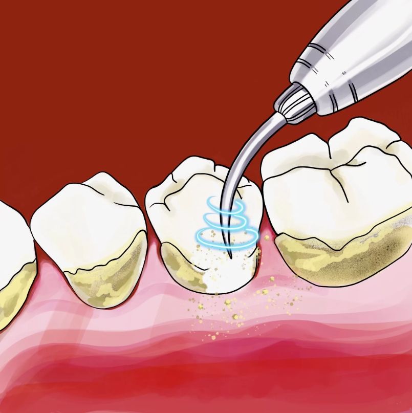 Удаление зубного камня