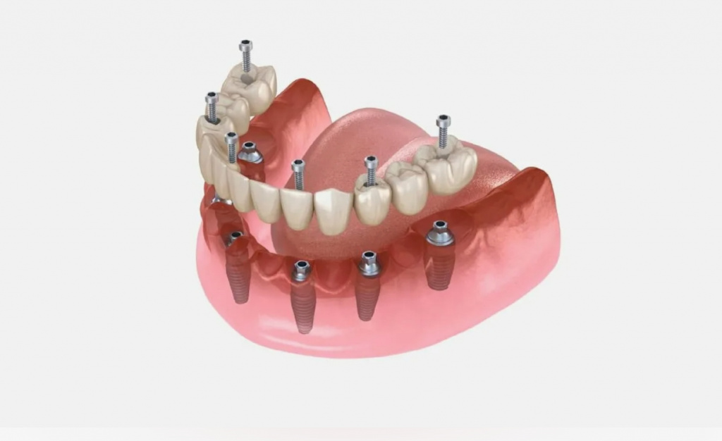 имплантация зубов на нижней челюсти