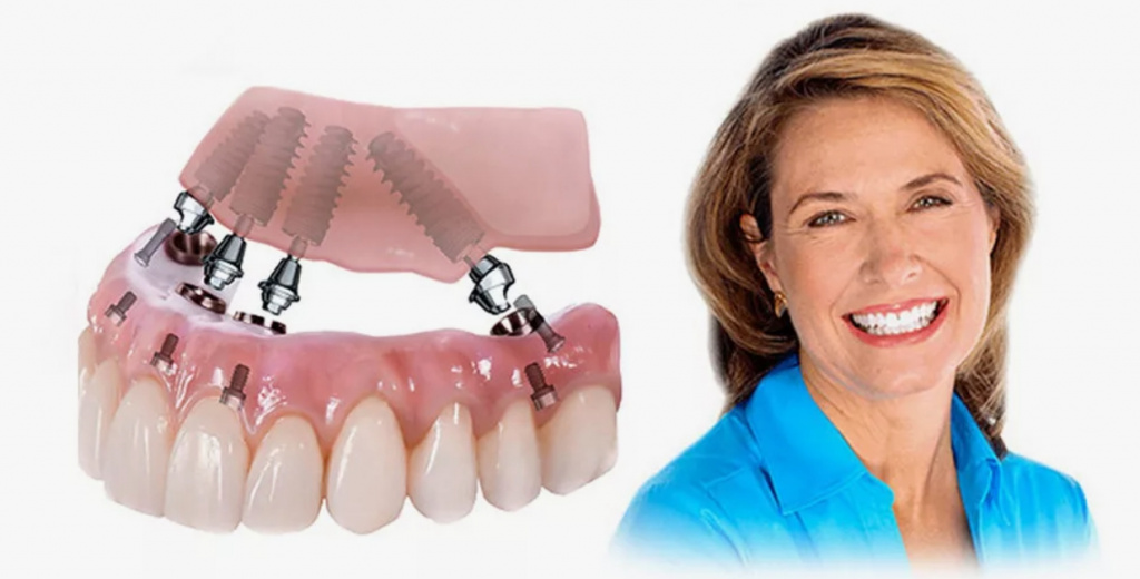 зубы на 4 имплантах