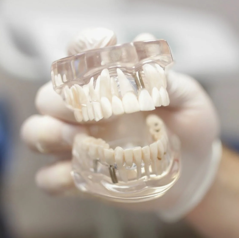 полное несъемное протезирование зубов