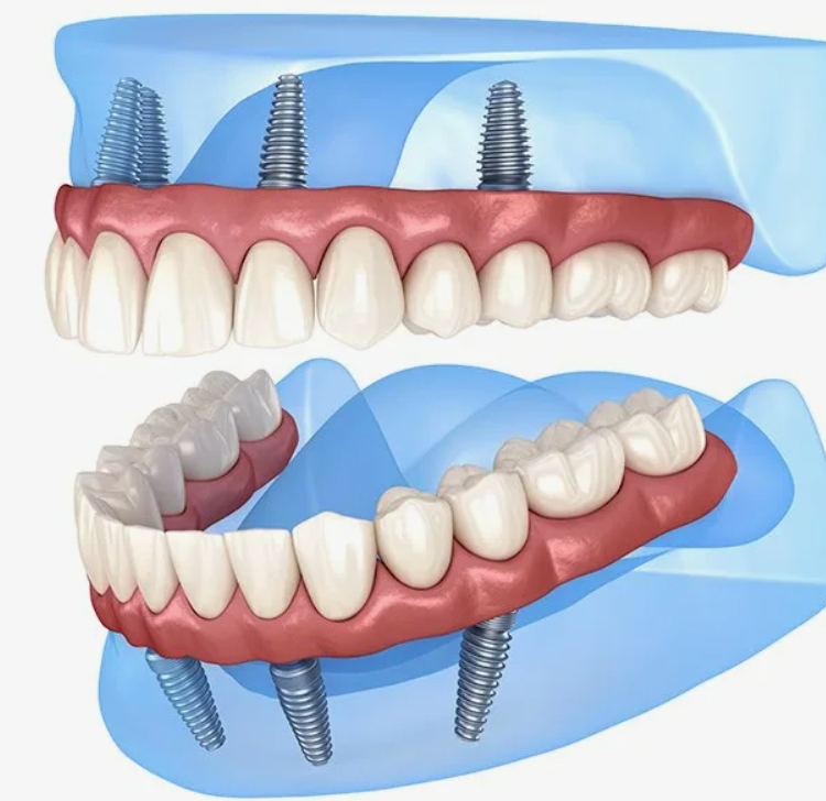 импланты верхних зубов