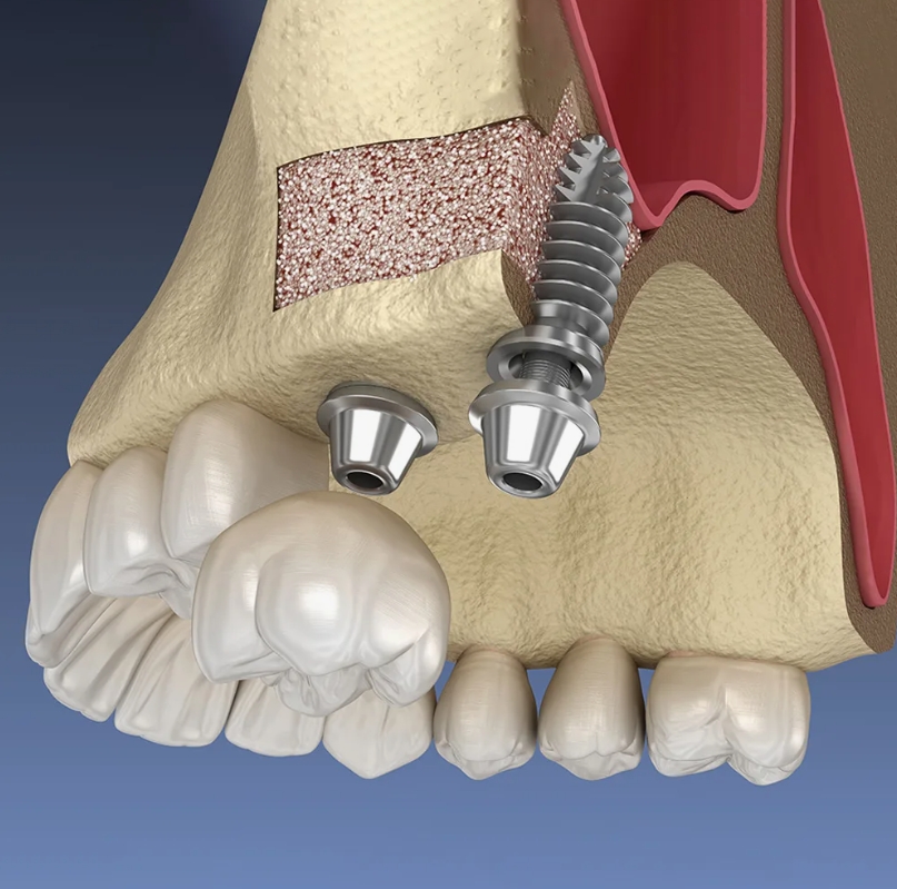 имплантация верхних зубов
