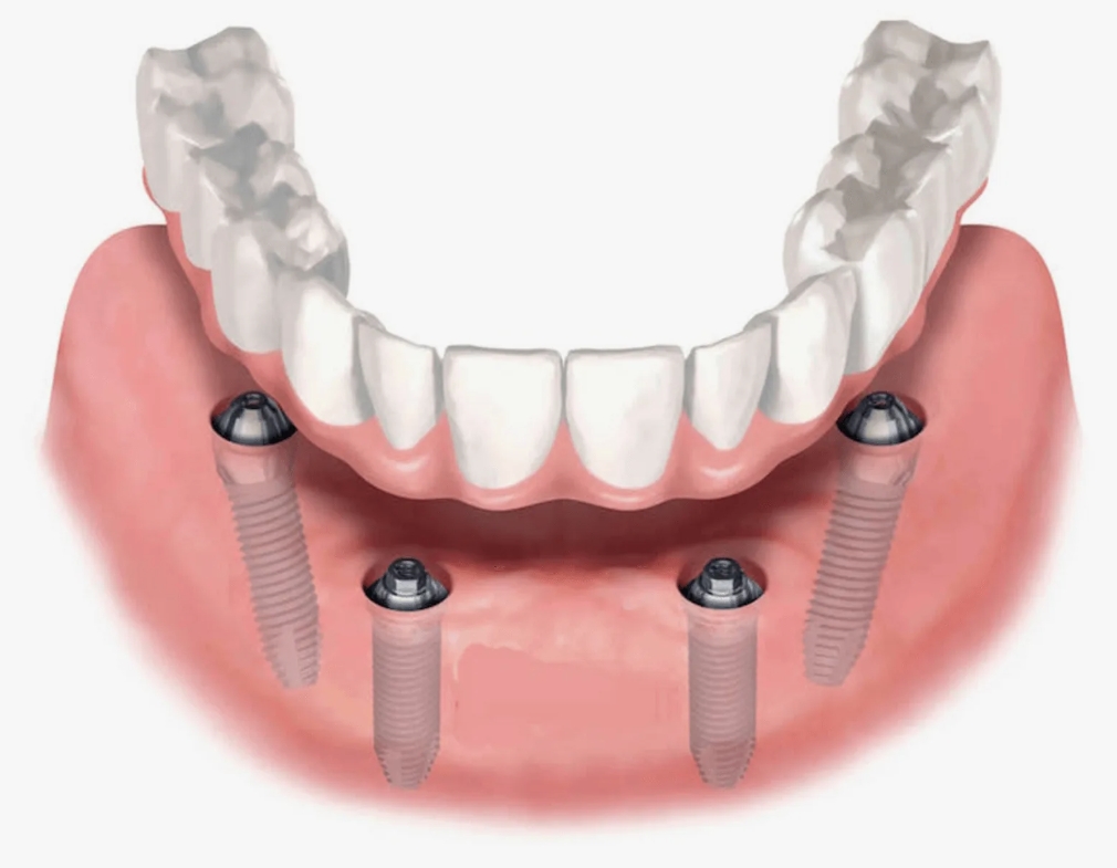 имплант зуба нижней челюсти